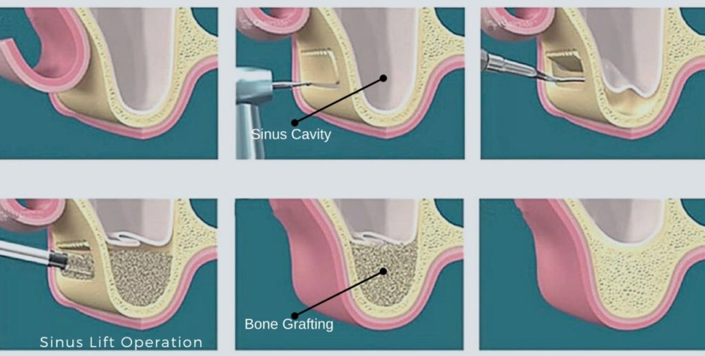 جراحی لیفت سینوس (Sinus Lift)