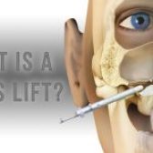 جراحی لیفت سینوس (Sinus Lift)
