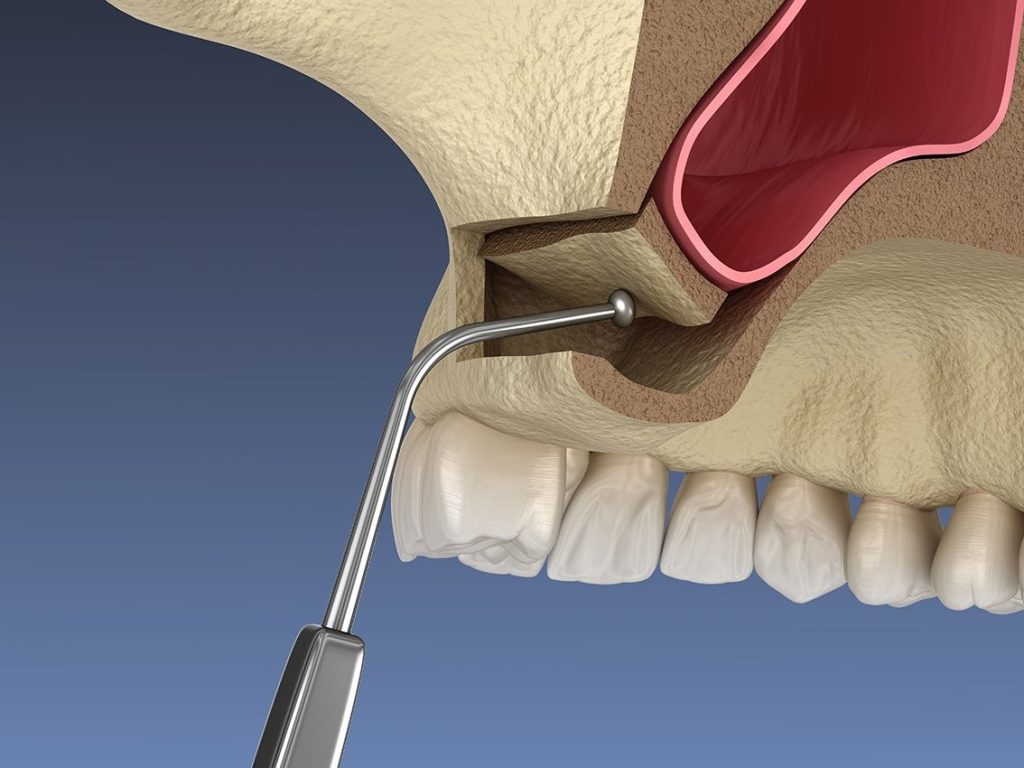 جراحی لیفت سینوس (Sinus Lift)