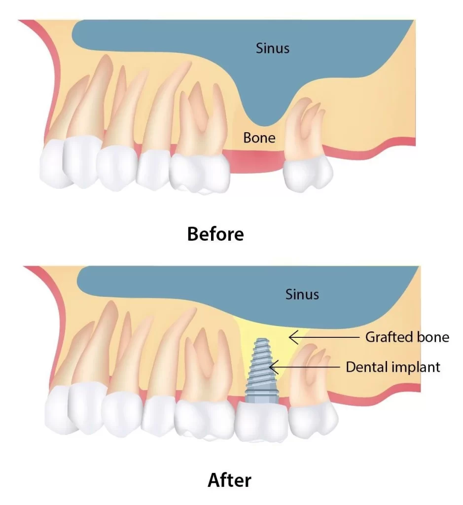 جراحی لیفت سینوس (Sinus Lift)