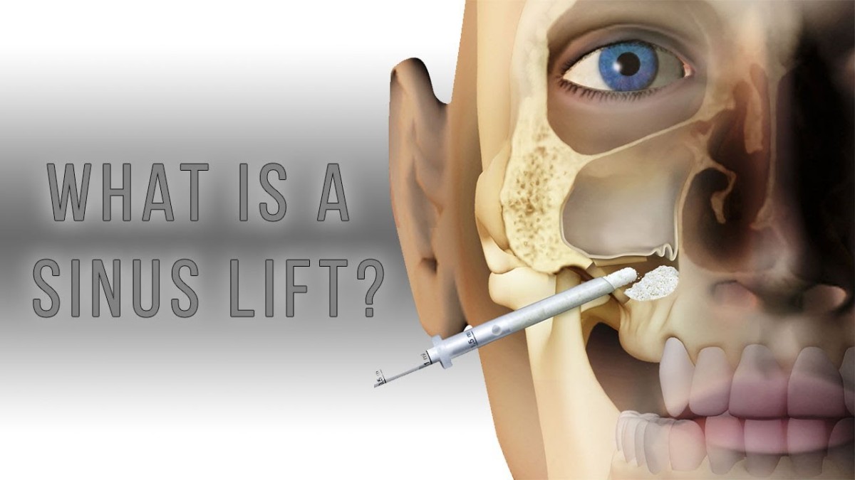جراحی لیفت سینوس (Sinus Lift)