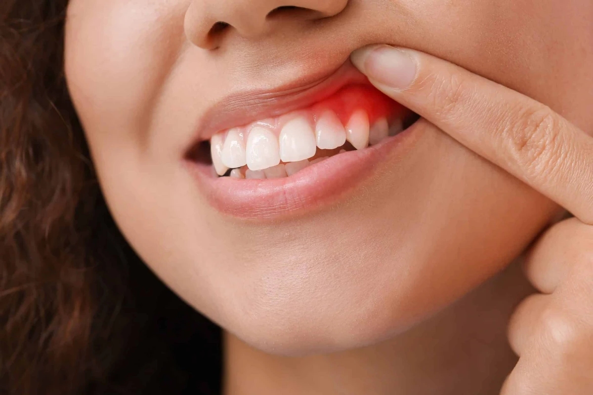 لثه حساس | حساسیت لثه