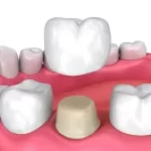 روکش موقت دندان
