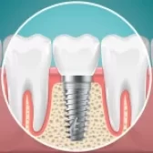 طول عمر ایمپلنت دندان
